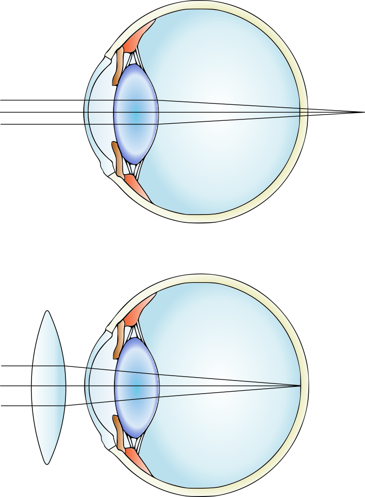 Two diagrams of an eye. An eye with uncorrected hyperopia is shown on top. There are parallel light rays that are incident on the eye, which focuses the rays behind the retina. An eye with a lens used to correct the hyperopia is shown on bottom. There are parallel light rays that are now focused onto the retina, due to the bending of light through the lens.
