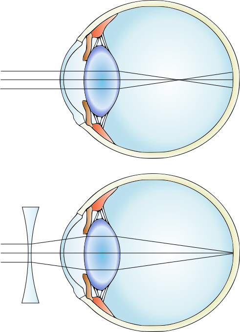 Two diagrams of an eye. An eye with uncorrected myopia is shown on top. There are parallel light rays that are incident on the eye, which focuses the rays in front of the retina. An eye with a lens used to correct the myopia is shown on bottom. There are parallel light rays that are now focused onto the retina, due to the bending of light through the lens.