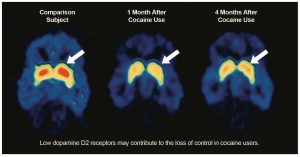 Illustration shows fMRI images comparing the brain of an individual with a history of cocaine use disorder to the brain of an individual without a history of cocaine use. The person who has had a cocaine use disorder has lower levels of the D2 dopamine receptor in the striatum one month and four months after stopping cocaine use compared to the non-user. The level of dopamine receptors in the brain of the cocaine user are higher at the 4-month mark, but have not returned to the levels observed in the non-user.