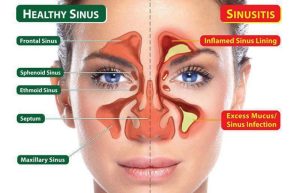 Traits of healthy sinus contrasted with sinusitis.