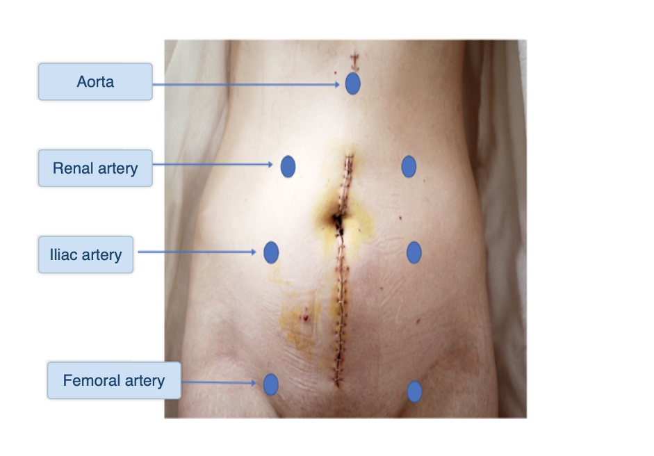 An abdomen with an arrow to the auscultory site of the aorta, renal arteries, iliac arteries, and femoral arteries.