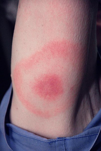 A bull's eye rash.