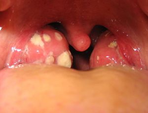 Inside of a person's mouth with tonsillitis