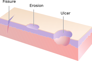 An animated image of a fissure, erosion, and ulcer (left to right) on the skin.