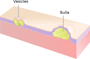 An animated image of vesicles and bulla.