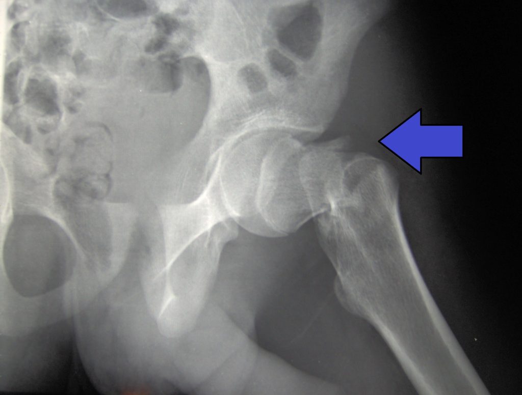 Xray image showing an arrow pointing at hip fracture