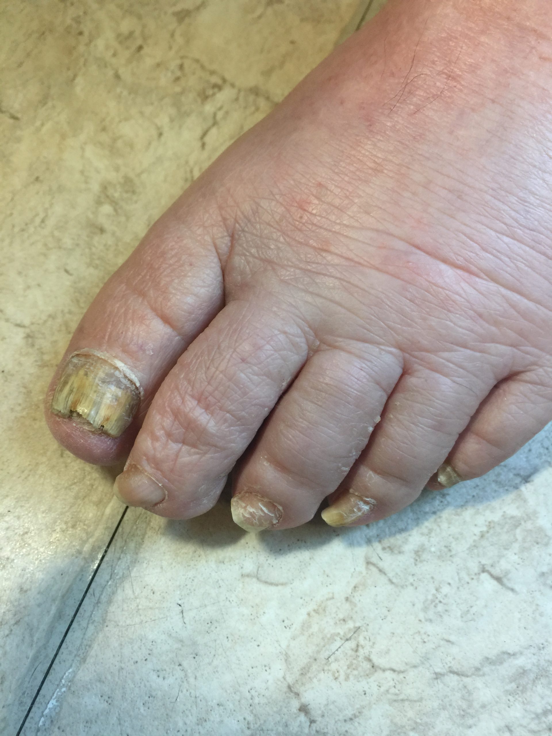 A person's left foot. The big toe is yellowish in colour and has nail fungus.