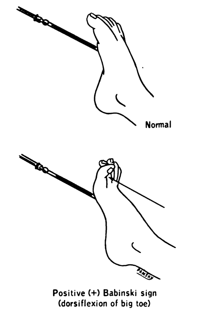 Illustration showing plantar reflex and babinski sign