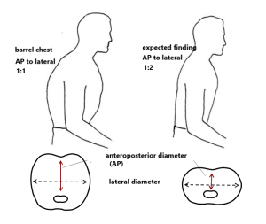 barrel chest