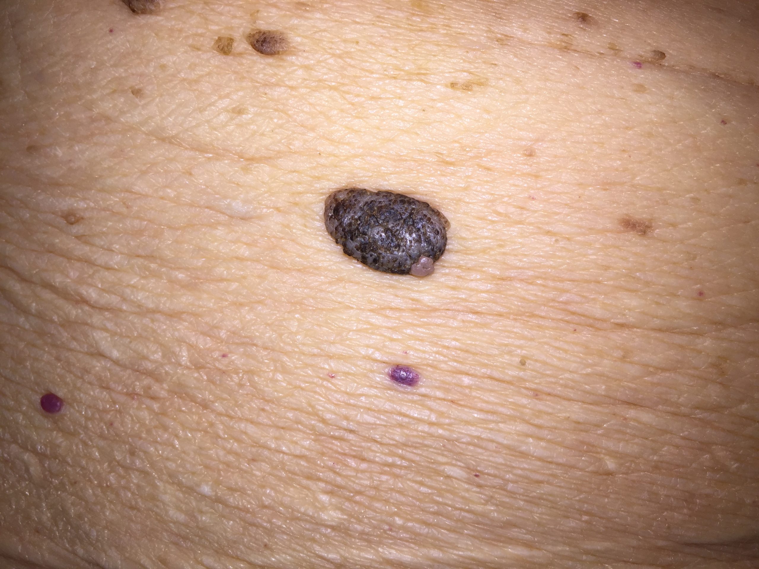 A dark brown raised lesion that is waxy with slight bumps throughout.