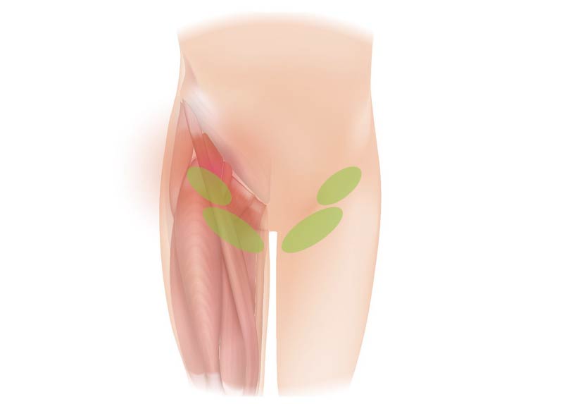 Lymph node areas identified with green ovals in the groin area.