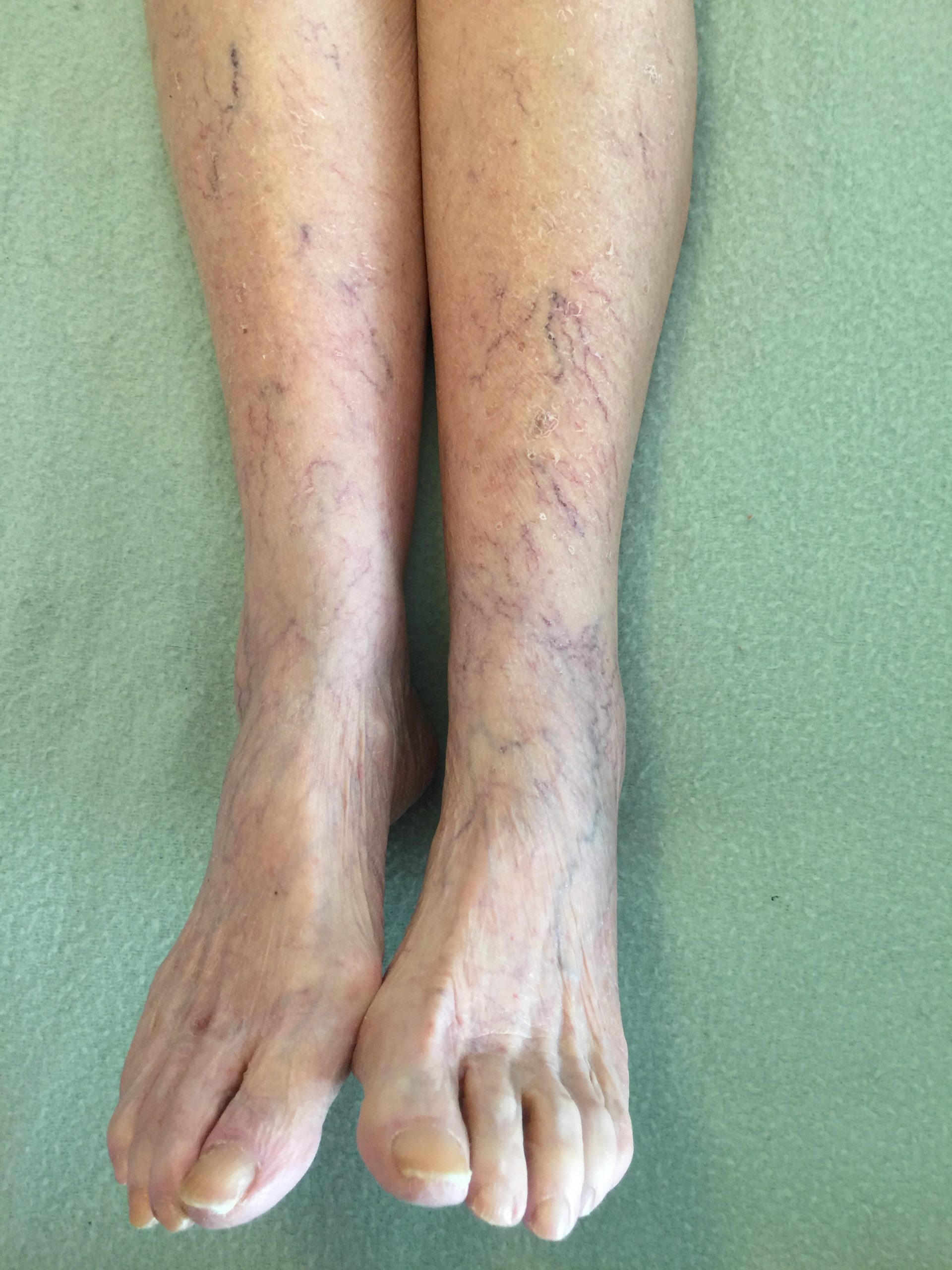 Flat small spider veins on legs.