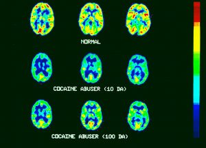 An image showing brain scans of non-addicts compared to those of chronic cocaine users. The brains of the cocaine users have significantly less dopamine activity.